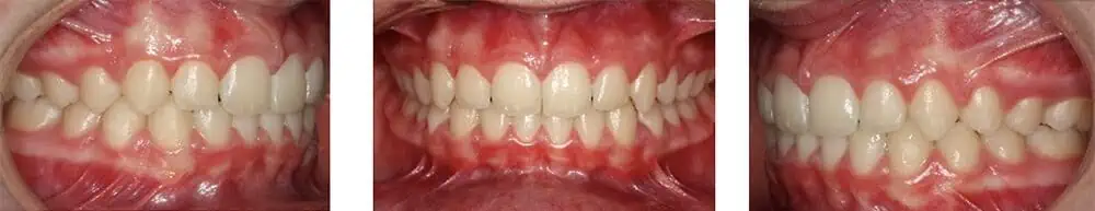 invisalign sobremordida imágenes y opiniones antes y despues