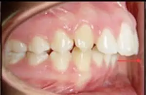 sobremordida horizontal invisalign