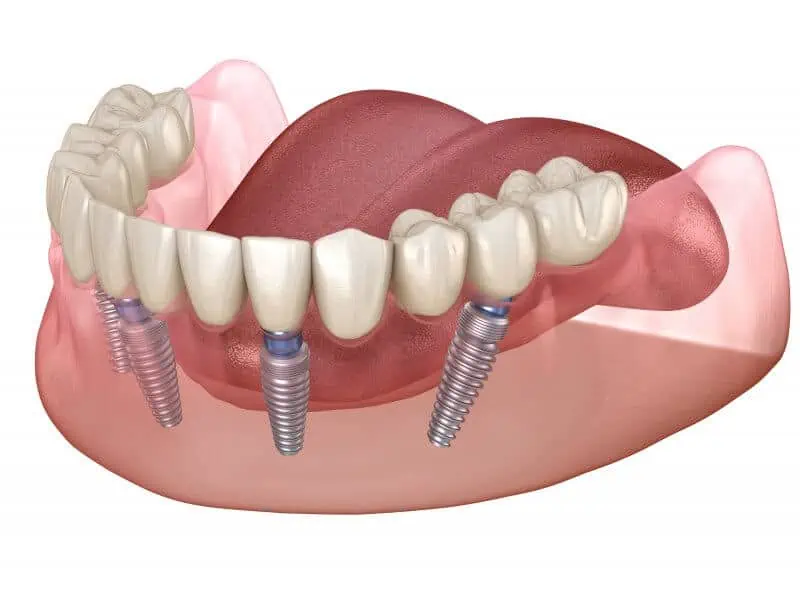 Dentadura completa sobre implantes