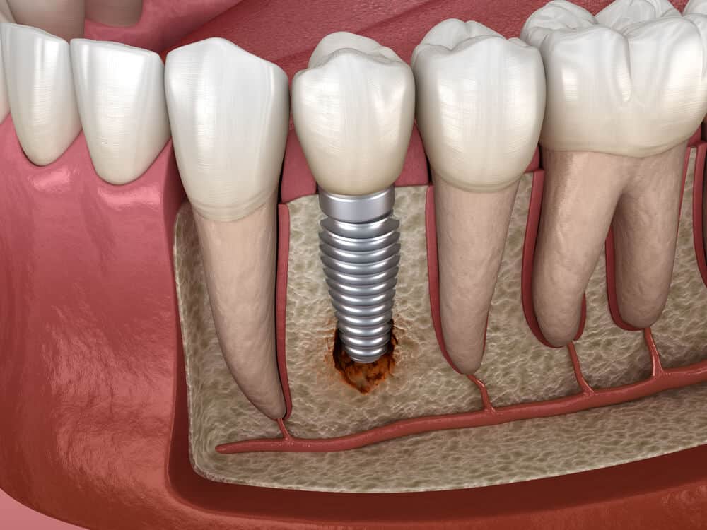Fotos de implantes dentales mal colocados