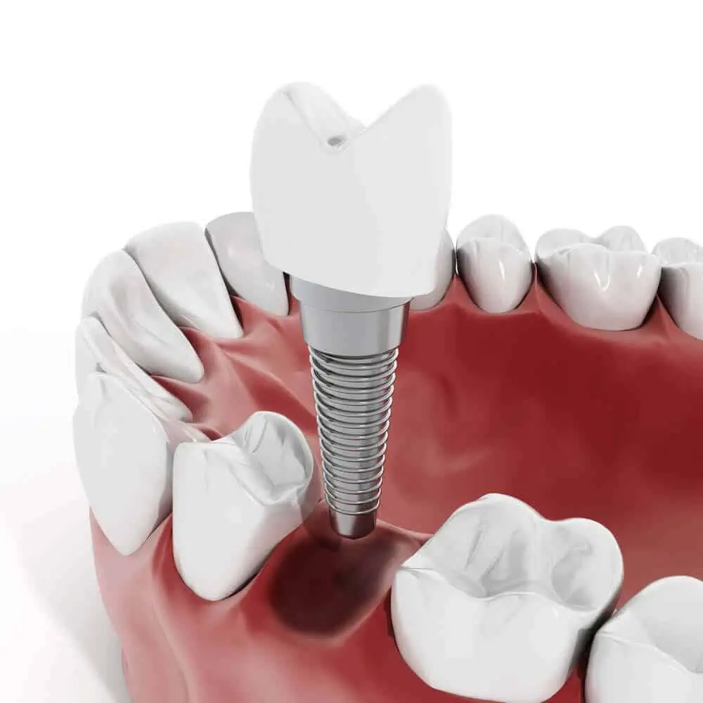 Fotos de implantes dentales mal colocados
