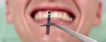 ¿Duele un implante dental?