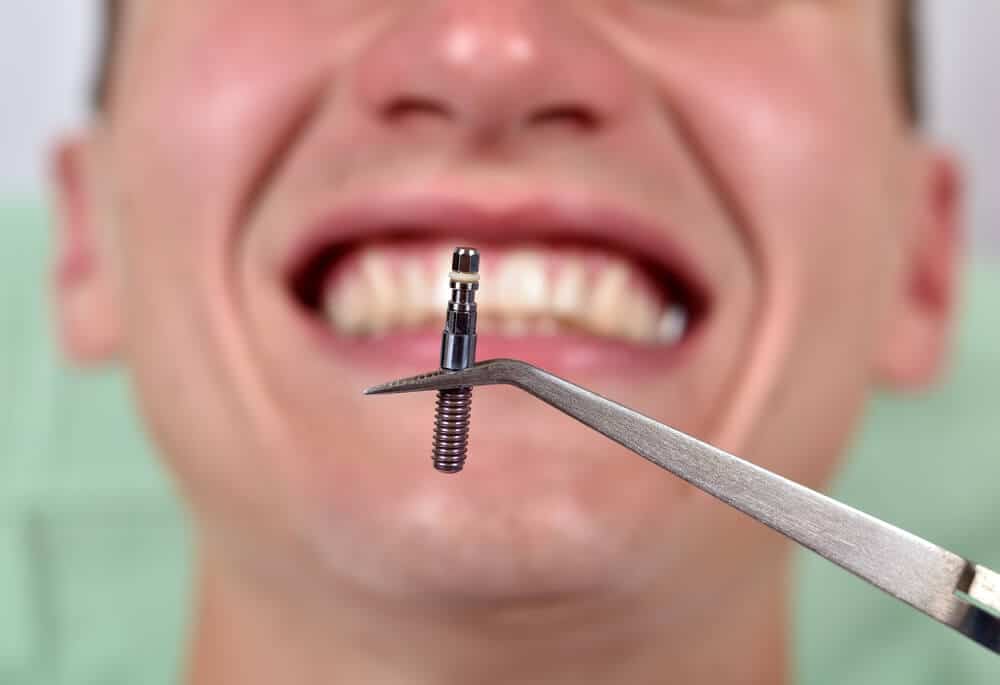 ¿Duele un implante dental?