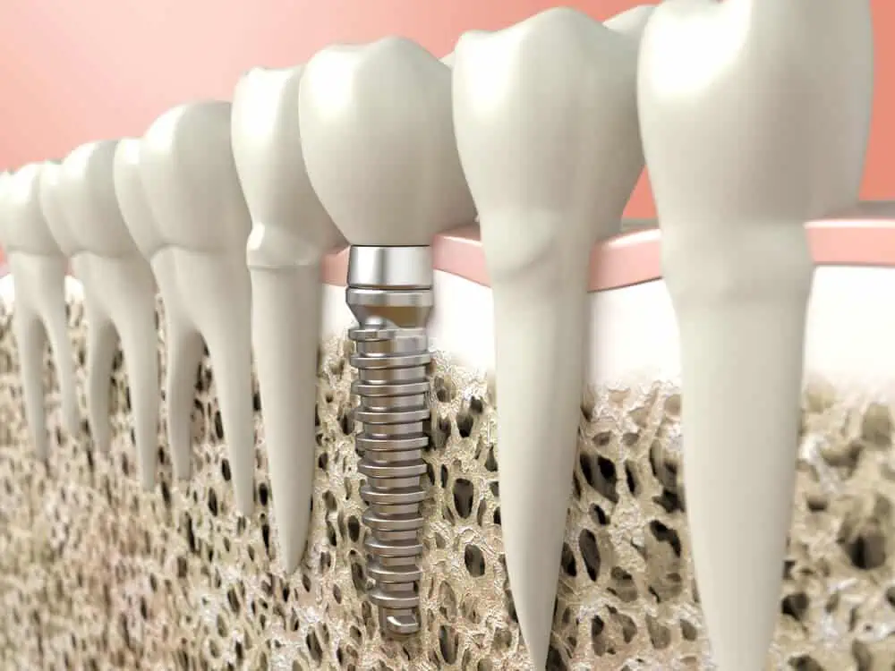 Implante dental partes