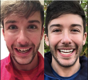 invisalign vs spark