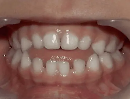 Mordida abierta invisalign