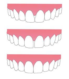 ipr invisalign