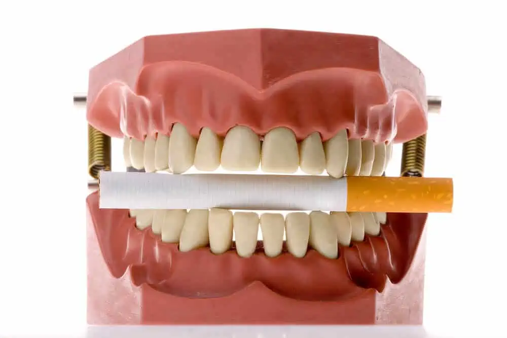 Opiniones de fumadores con implantes dentales