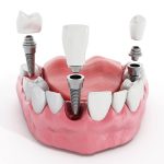 27331¿Qué es CAD CAM dental y cómo se aplica en odontología?