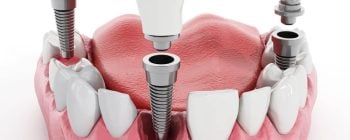 Partes de los implantes dentales