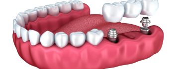 Puente sobre implantes