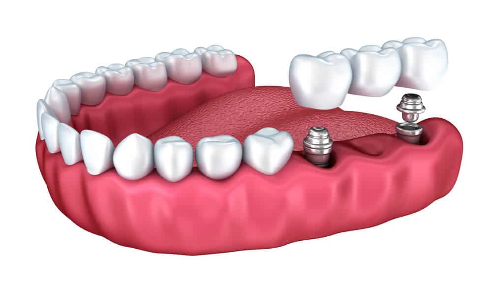 Puente sobre implantes