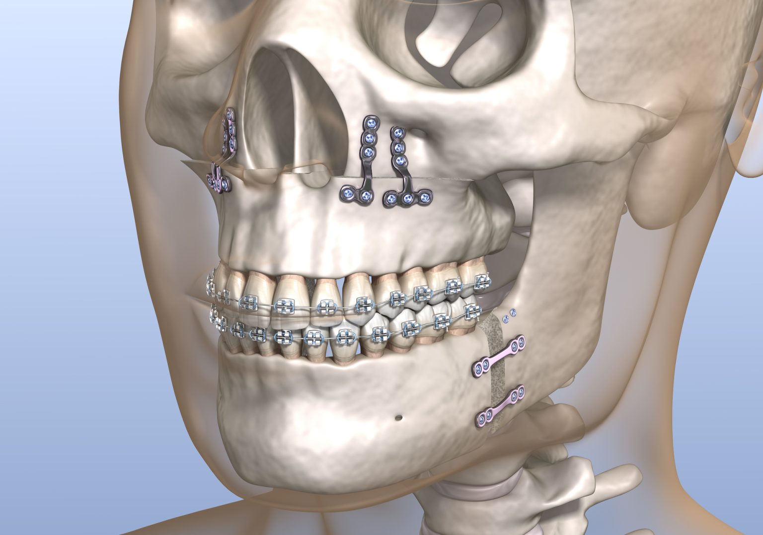 Retrognatia mandibular ¿Cuáles son sus causas?