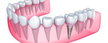 postoperatorio implante dental