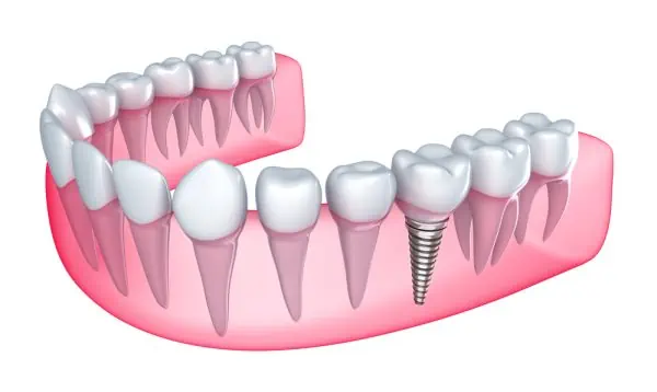postoperatorio implante dental