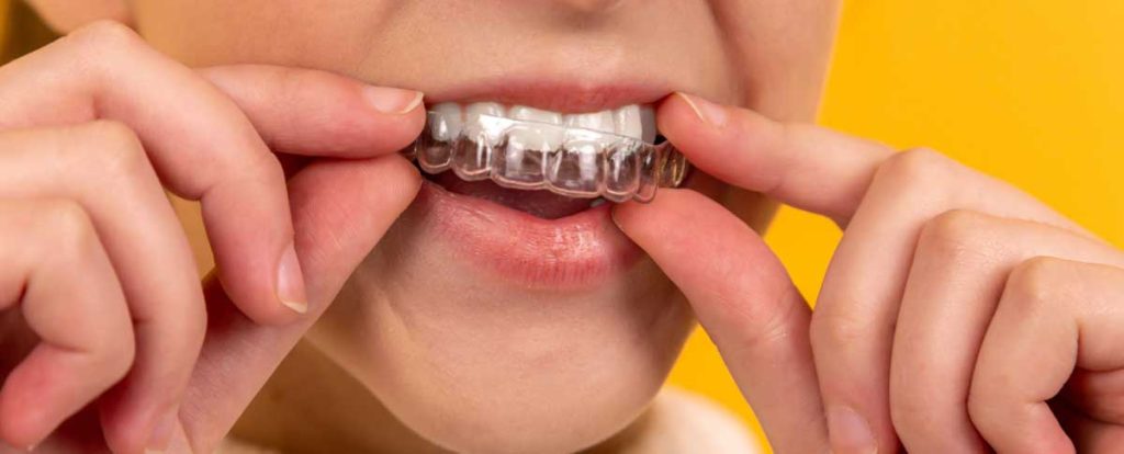 invisalign first opiniones