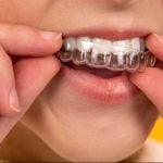 27999Flúor dental: ¿qué es y es bueno demasiado flúor para los dientes?