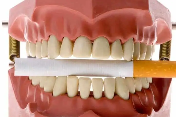 fumadores con implantes dentales