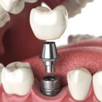 28162Puente sobre implantes dentales: qué es, beneficios y preguntas frecuentes
