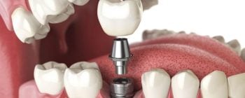 Riesgos implantes dentales de titanio