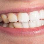 28382Famosos con dientes separados: cómo el diastema se ha convertido en un rasgo atractivo