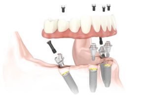 implantes all on four en polonia