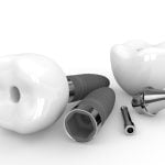 31642Un implante para dos muelas: ¿Cuántos implantes dentales debo ponerme? 