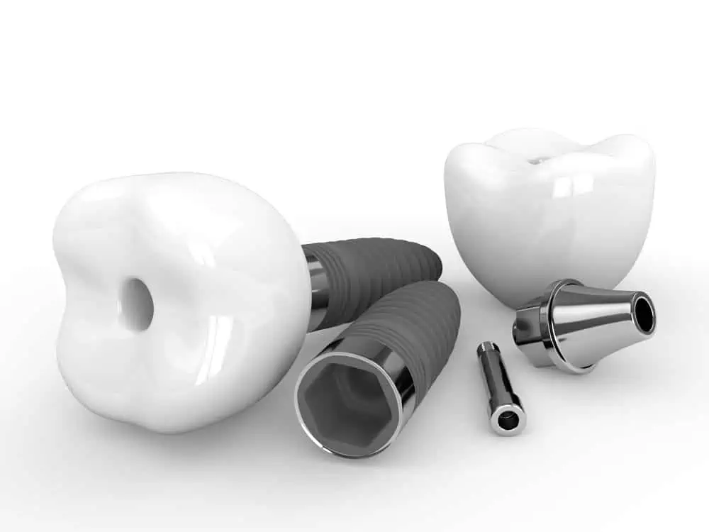 implantes dentales atornillados o cementados