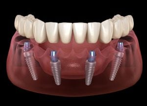 implantes dentales en sofia