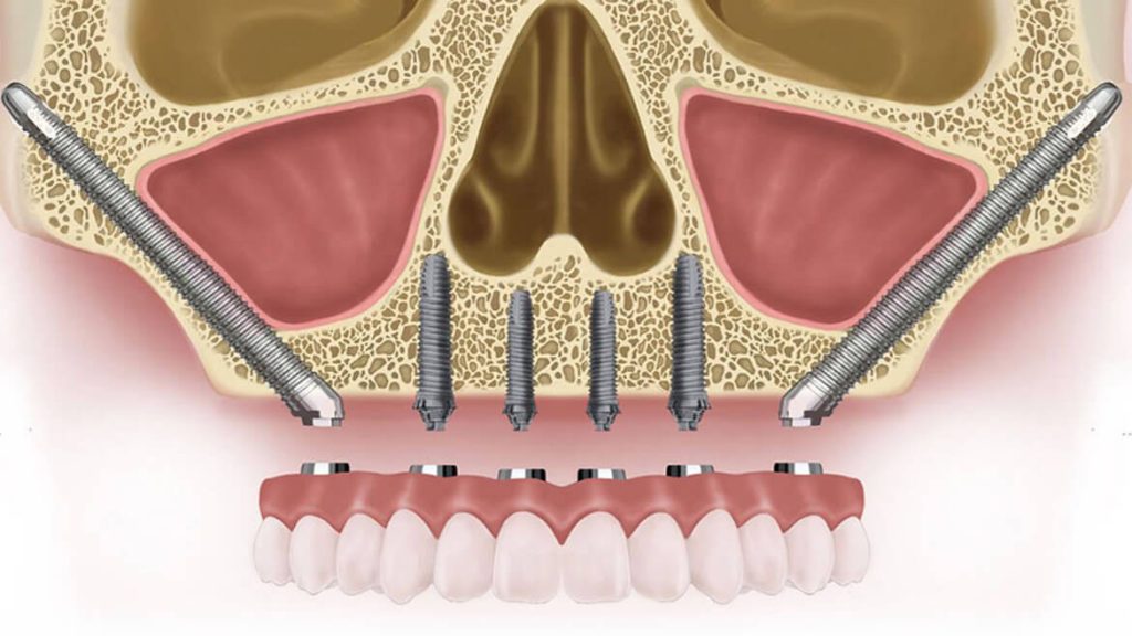 implantes cigomáticos