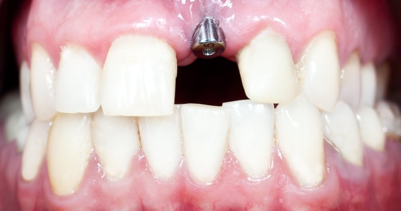 Implantes dentales en un día o 24 horas