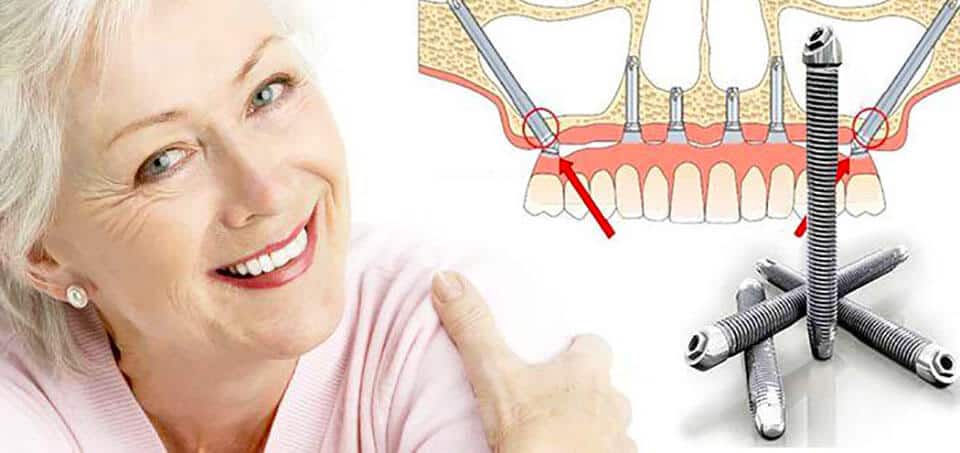 Implantes cigomáticos problemas