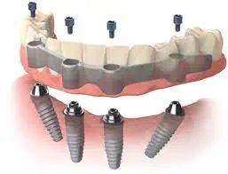 Opiniones Implantes Biohorizons