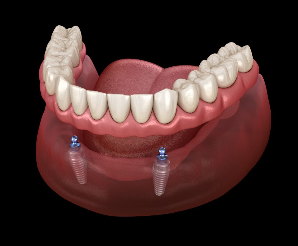 Sobredentadura sobre 2 implantes