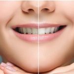 47692Extracción dental: ¿Cómo recuperarte rápido de una exodoncia?