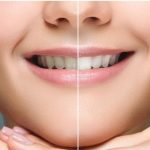 47692Mejor blanqueador dental: precios, opiniones y tratamientos