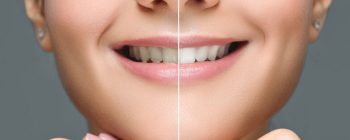 cómo hacer un blanqueamiento de dientes casero rápido