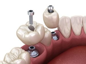 implante dental atornillado