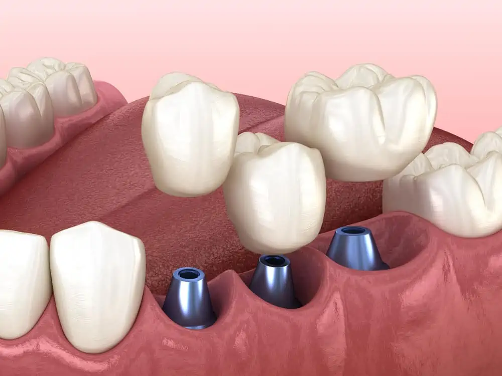 Implante dental cementado