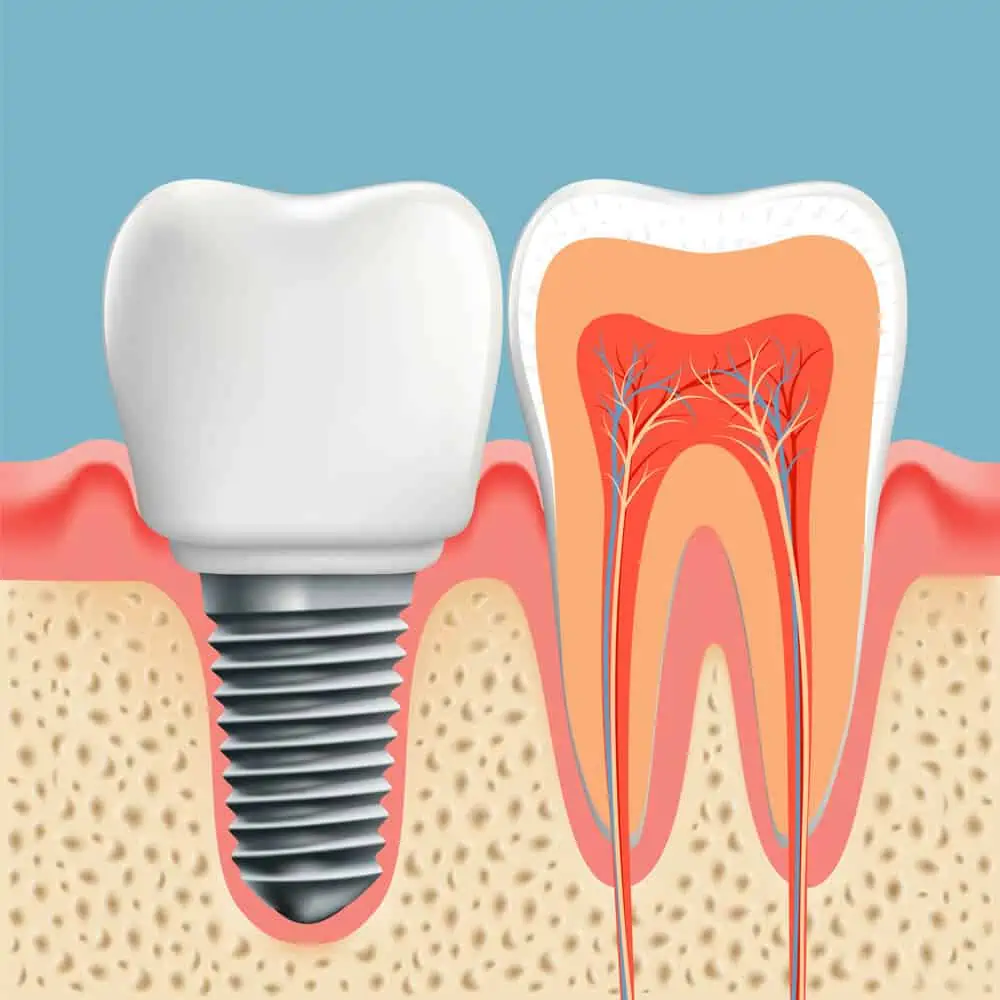 Implante dental fuera de la encía