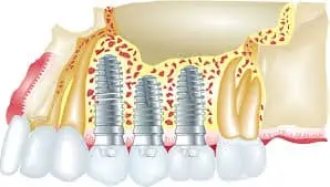 Implantes endoóseos osteointegrados