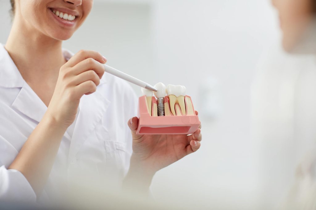 Implantes dentales a 250 euros