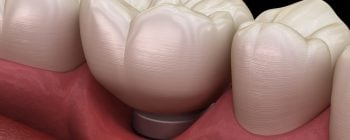 Implantes dentales problemas