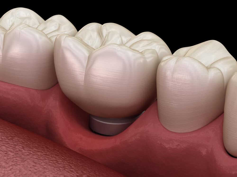 Implantes dentales problemas