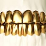 permanent gold teeth implants