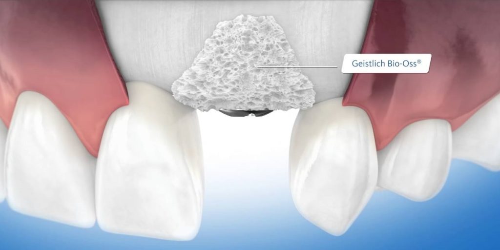 Problemas implantes dentales - Injerto de hueso