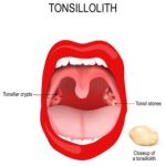 52326Blanqueamiento dientes sensibles: Kits y tiras para dientes sensibles