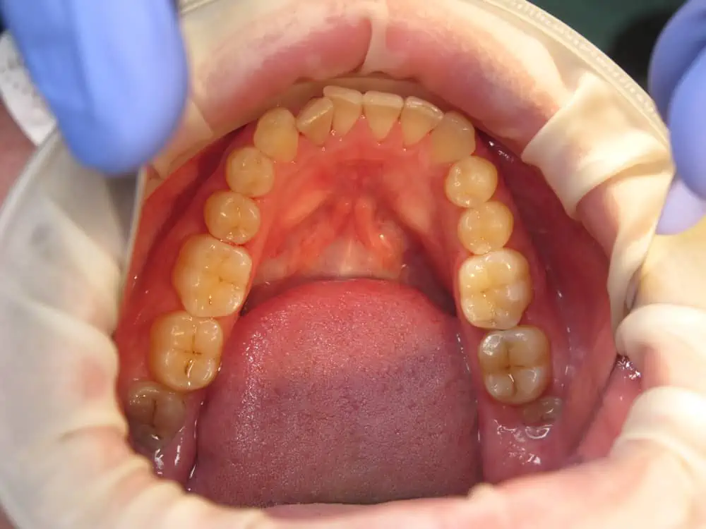 torus mandibular fotos
