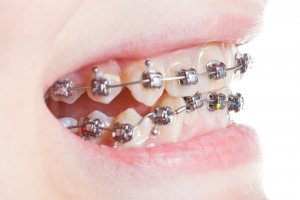 braces straightening teeth