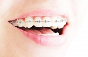 clear braces smile